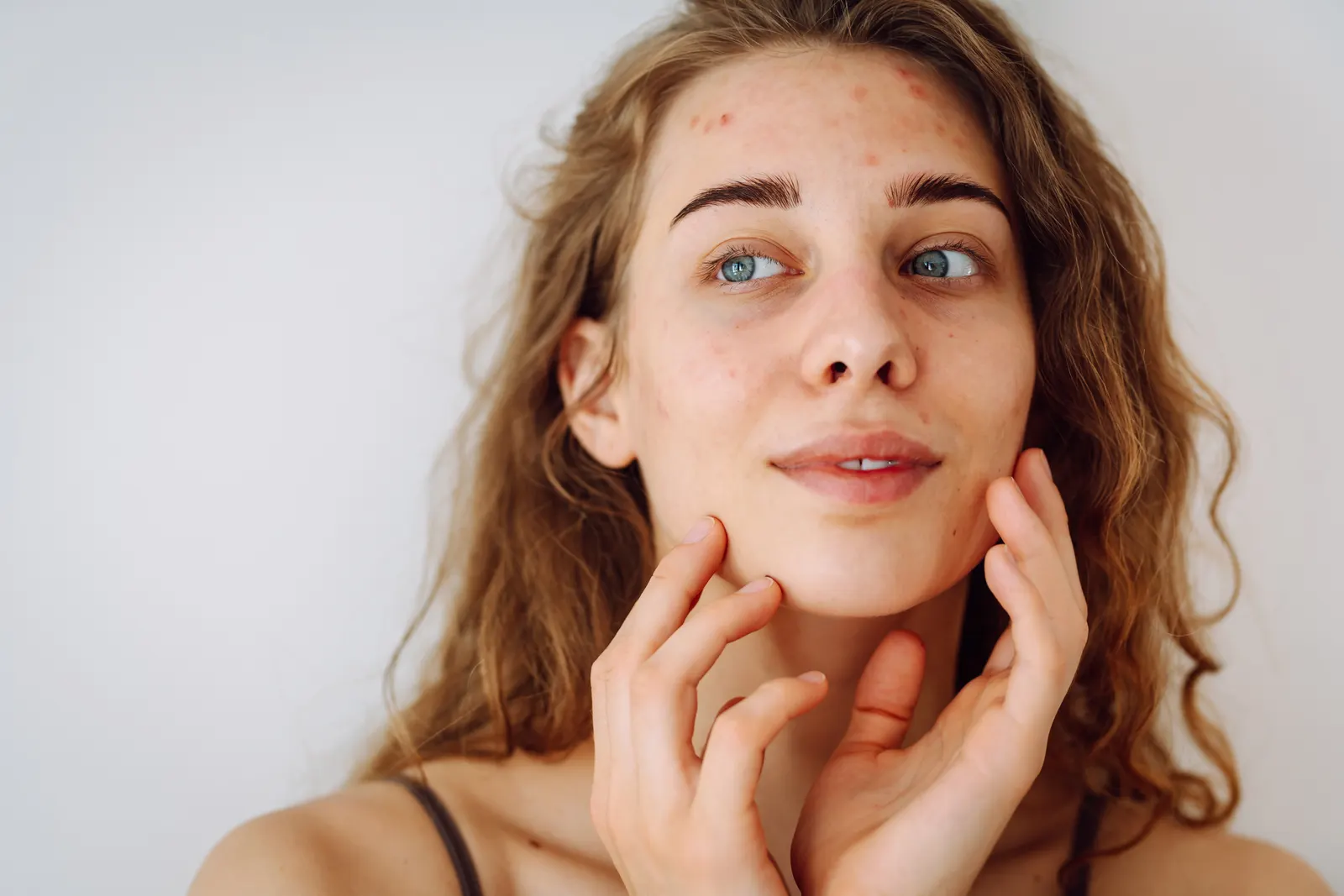 Active breakouts on young adult skin