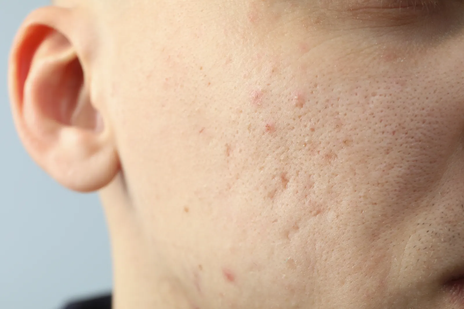 Post-acne scarring on a cheek