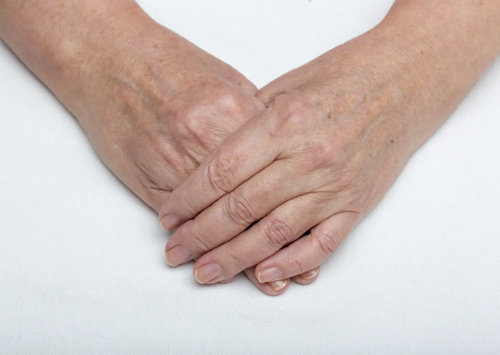 Sun spots on skin before laser pigmentation removal