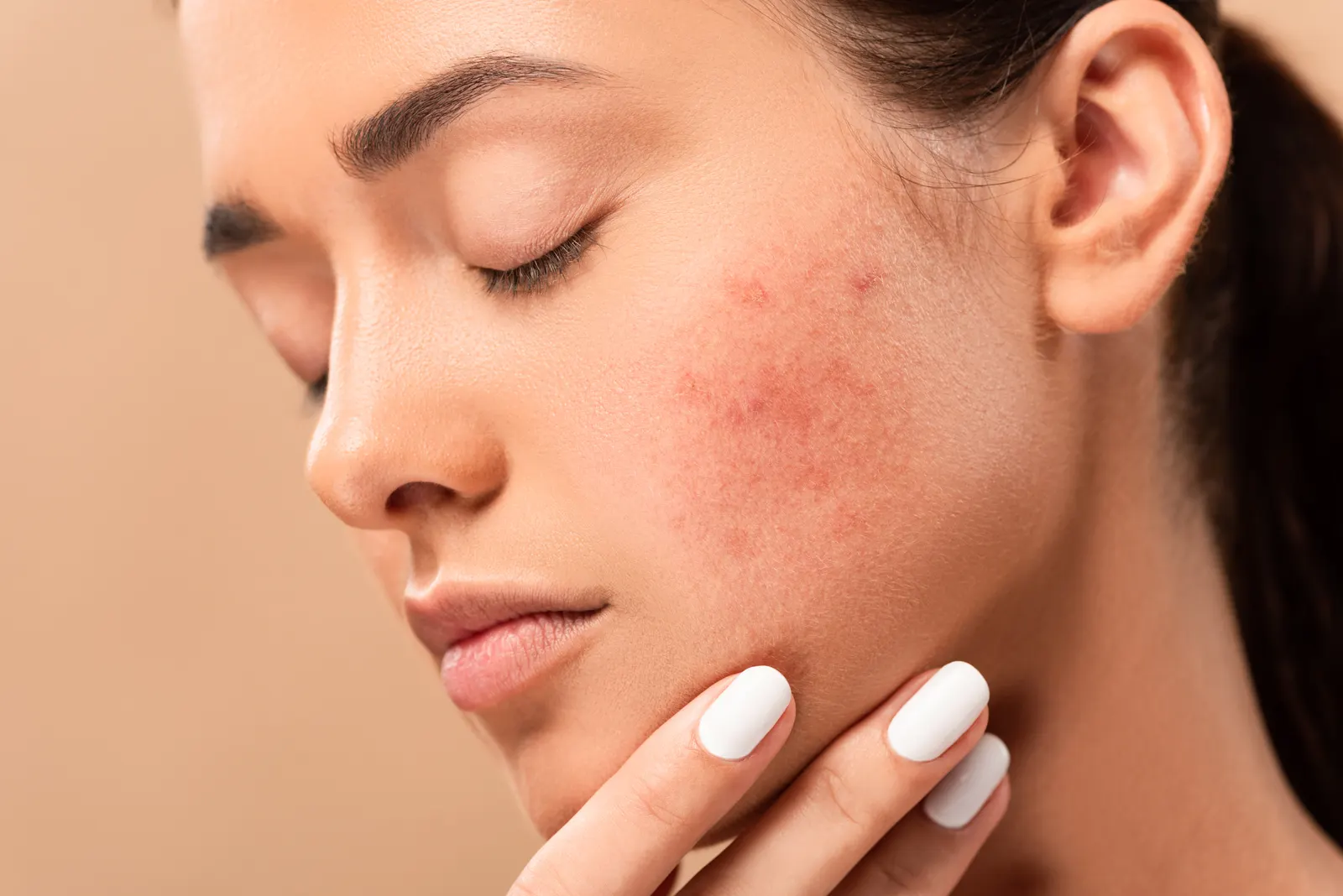 Rosacea redness across the cheeks