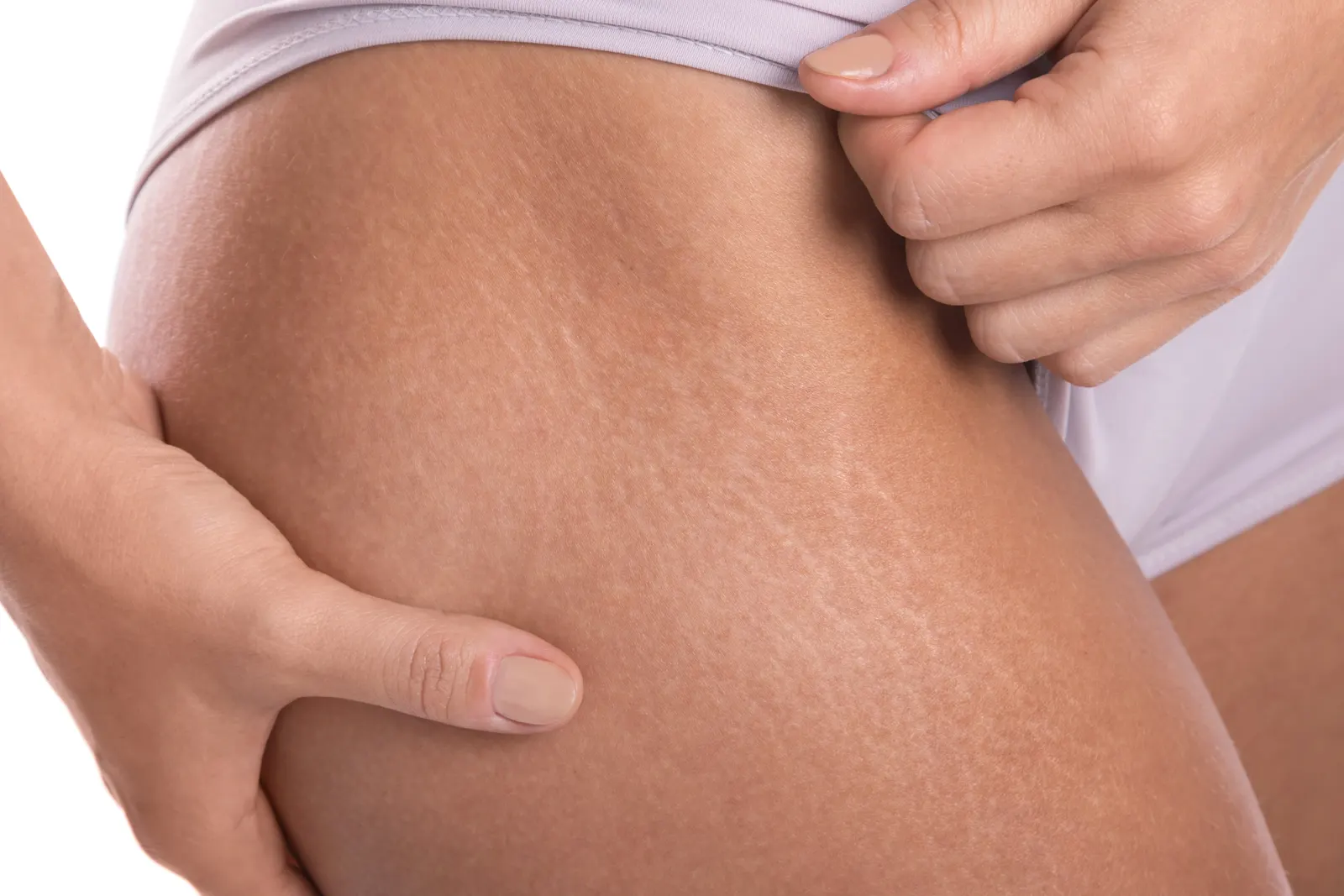 Stretch marks across skin in natural light