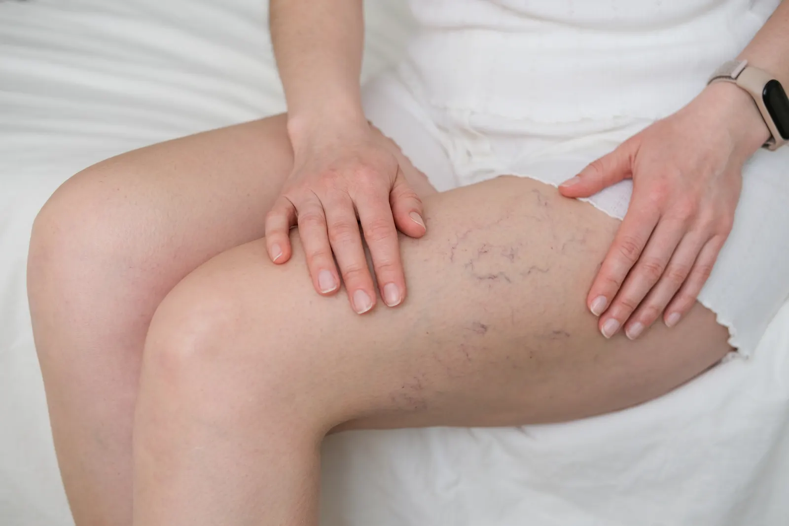 Spider veins visible on a leg